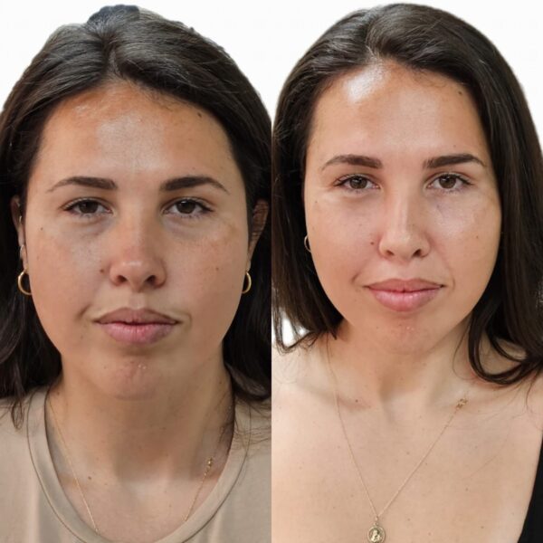 Lower Face Restoration