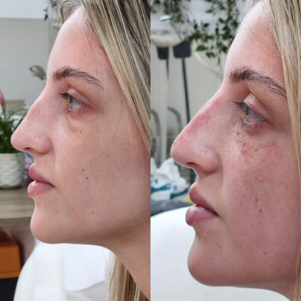 Non Surgical Nose Reshape