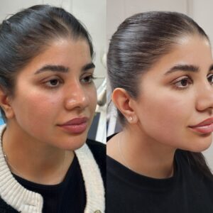 Lower Face Restoration