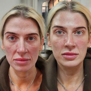 Mid-face Restorations
